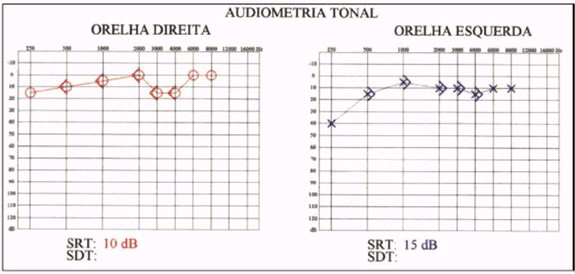 audiometria1